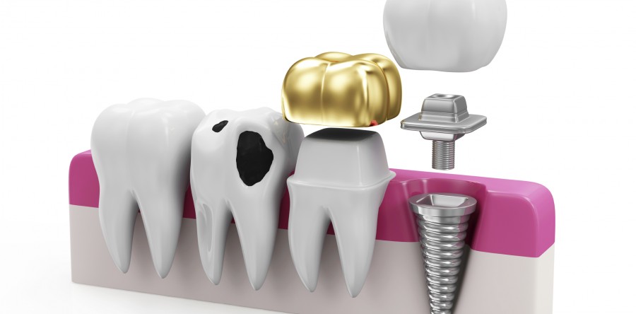 Implantate